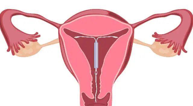 关于产后几个月可以上环的探讨