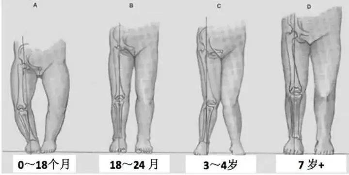 十个月宝宝的腿型发展，关注腿不直的现象