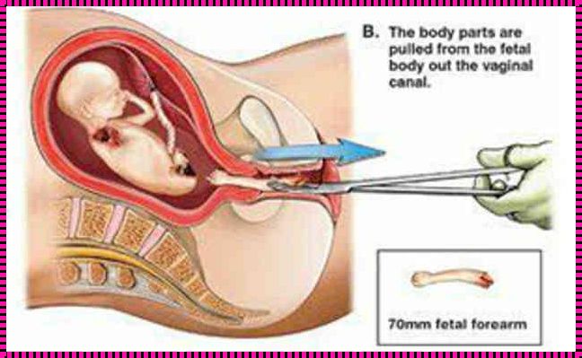 关于三个月人流与引产的探讨
